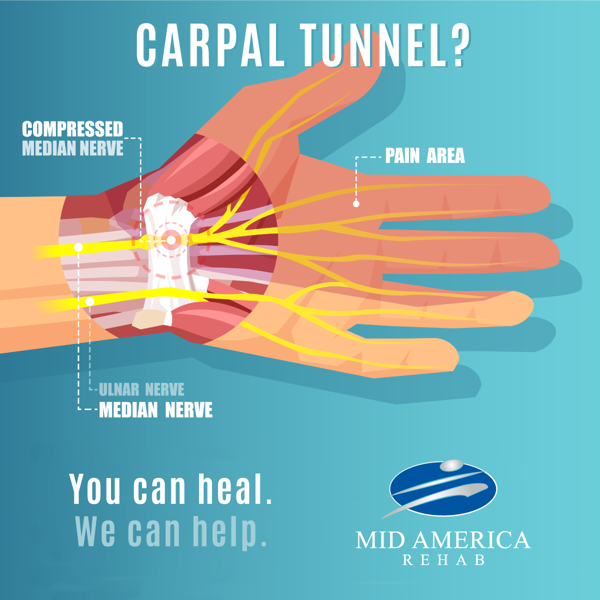 Featured image for “The Amazing Benefits of Physical Therapy for Carpal Tunnel Syndrome”