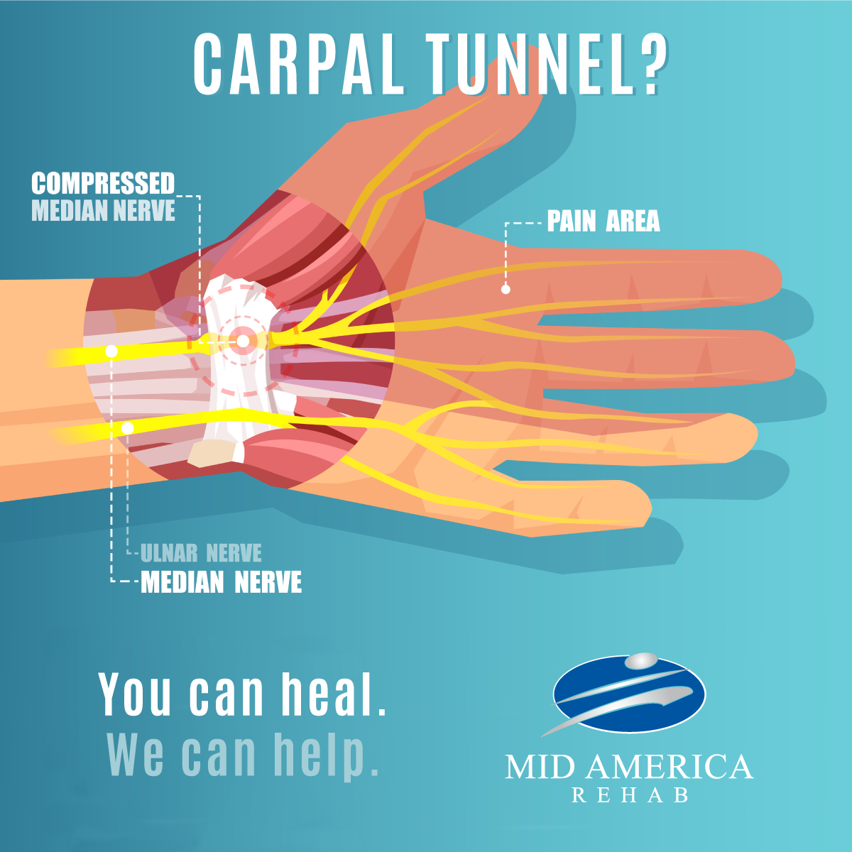 The Amazing Benefits of Physical Therapy for Carpal Tunnel Syndrome - Mid  America Rehab